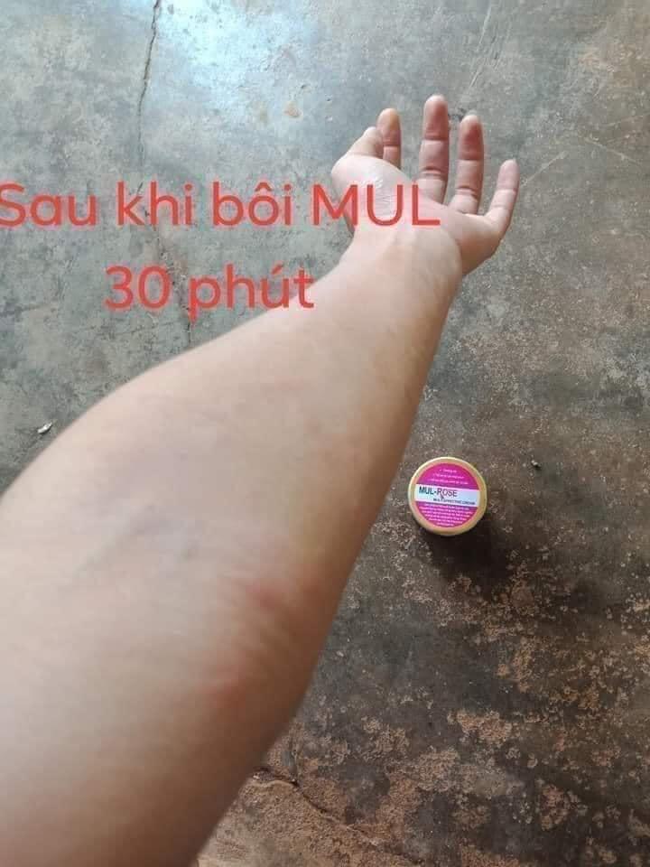 Organic Cream cure burn ,itchy , eczema 30g, Beauty & Personal Care