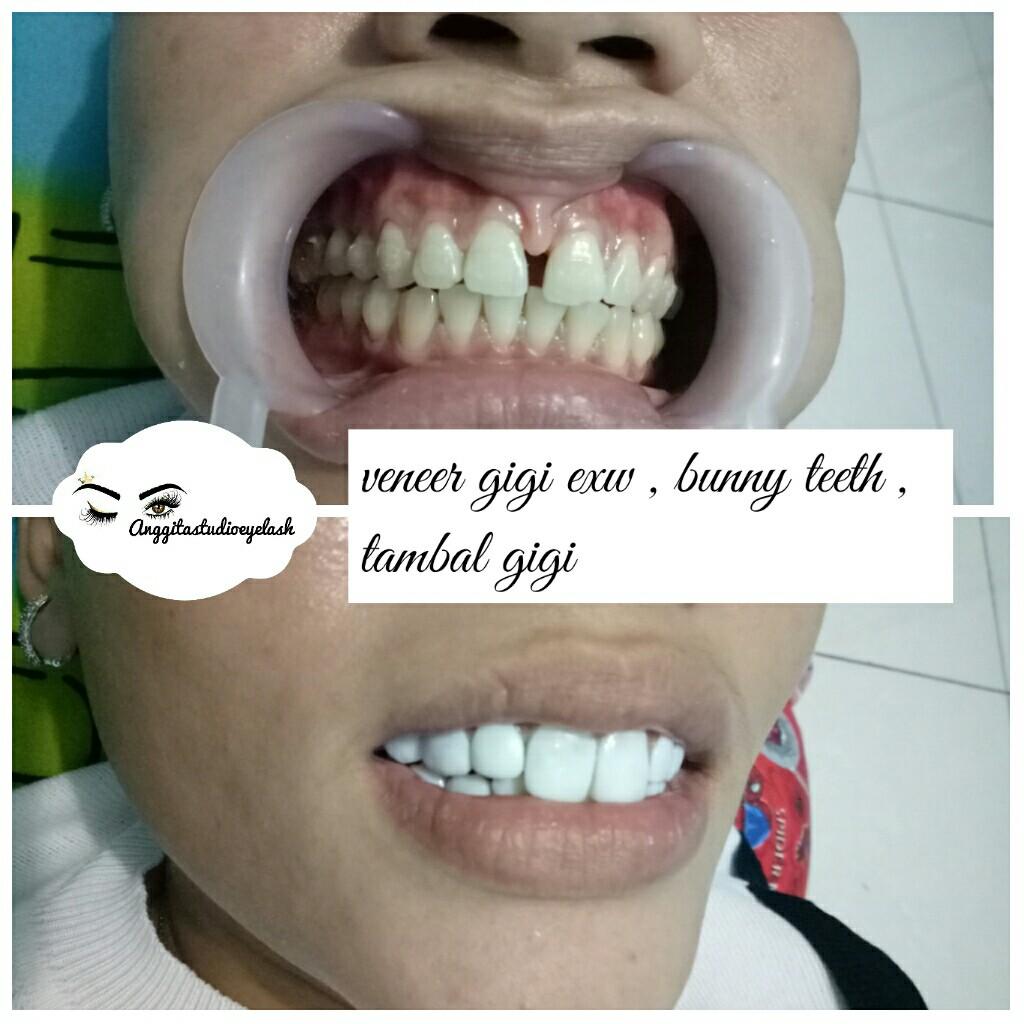 Veneer Gigi Tambel Gigi Jasa Beauty Services Di Carousell Veneer Gigi Tambel Gigi Jasa Beauty Services Di Carousell