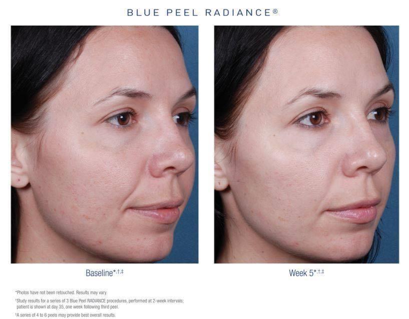 obagi nu derm week 4