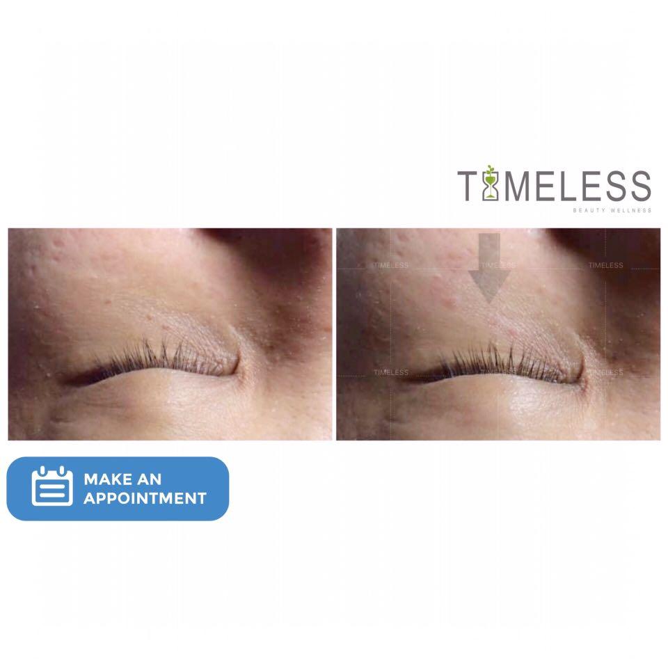 SKIN REMOVAL TREATMENT, Beauty & Personal Care, Face, Face Care on