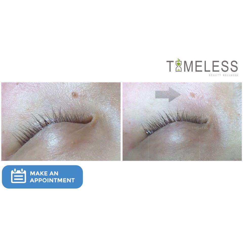 SKIN REMOVAL TREATMENT, Beauty & Personal Care, Face, Face Care on