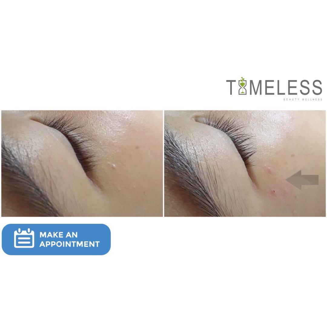 SKIN REMOVAL TREATMENT, Beauty & Personal Care, Face, Face Care on