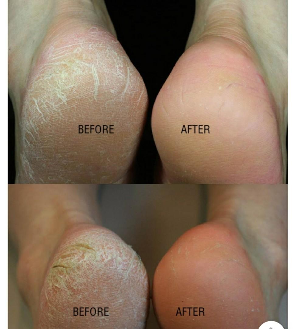 Baren foot exfoliation pack/foot callus eraser home kit, Beauty