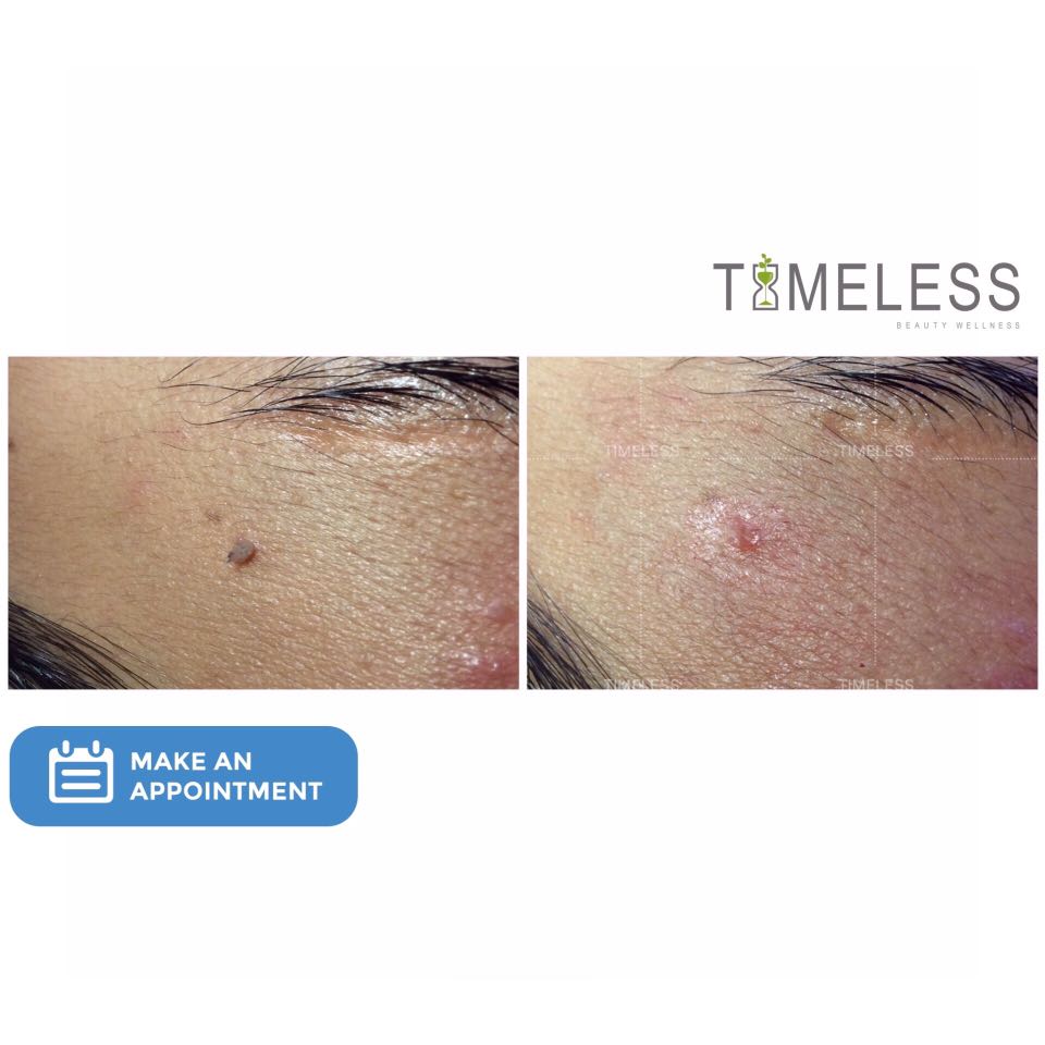 SKIN REMOVAL TREATMENT, Beauty & Personal Care, Face, Face Care on