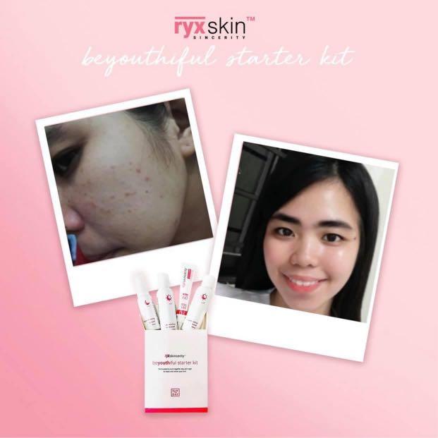 Ryx Skincerity beYouthiful Starter Kit (Category: Face Care) located in Mandaluyong City. Submitted by charlaloooo (Listing ID 1014276014, Image 2). Description: Miss niyo na? 😍 Available na po ulit! Limited stocks only❤️ #RyxSkin #BeYouthifulStarterKit #NotYourOrdinaryRejuvenatingSet #RyxRejuvenatingSet #RyxSkincerityMandaluyong.