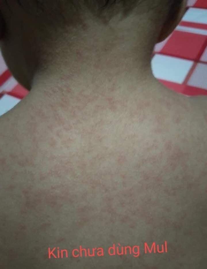Tumerac Rash Rash skin , eczema, dry skin cream turmeric Mul Rose, Health & Beauty ...