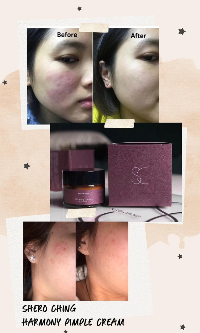 3g cream for pimples