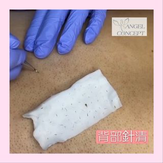 去黑頭. 粉刺 皇牌針清護理 Collection item 2