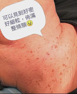 脫疣~女士頸部~密佈式生長😣64246533809922110