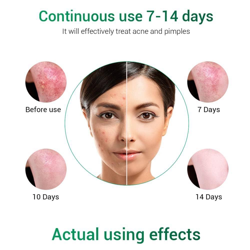 accutane pills price