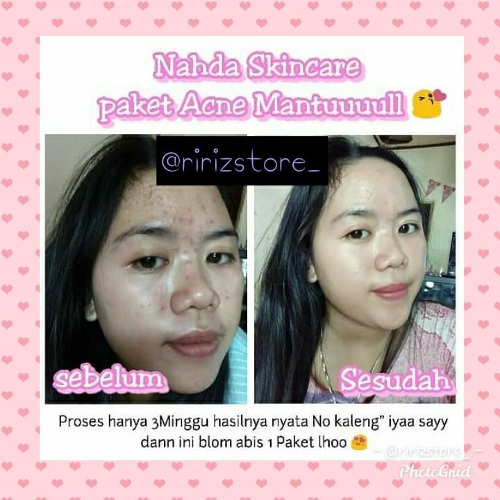 Nahda skincare acne sale