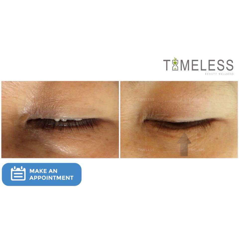 SKIN REMOVAL TREATMENT, Beauty & Personal Care, Face, Face Care on