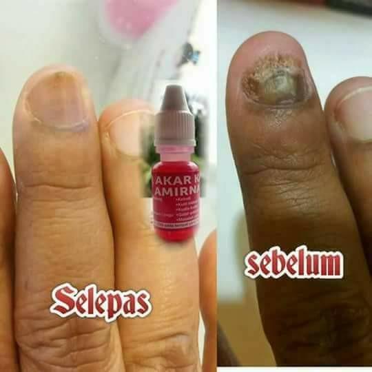 AMIRNA AIR AKAR KAYU / SINUS / RESDUNG / WOUNDS / LUKA ...