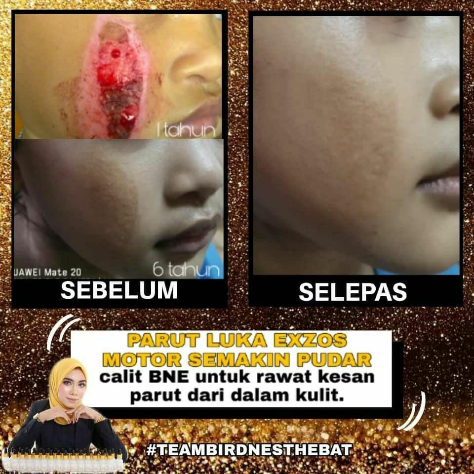 SERUM BNE / BIRD NEST ESSENCE SERUM / ACNE / JERAWAT ...