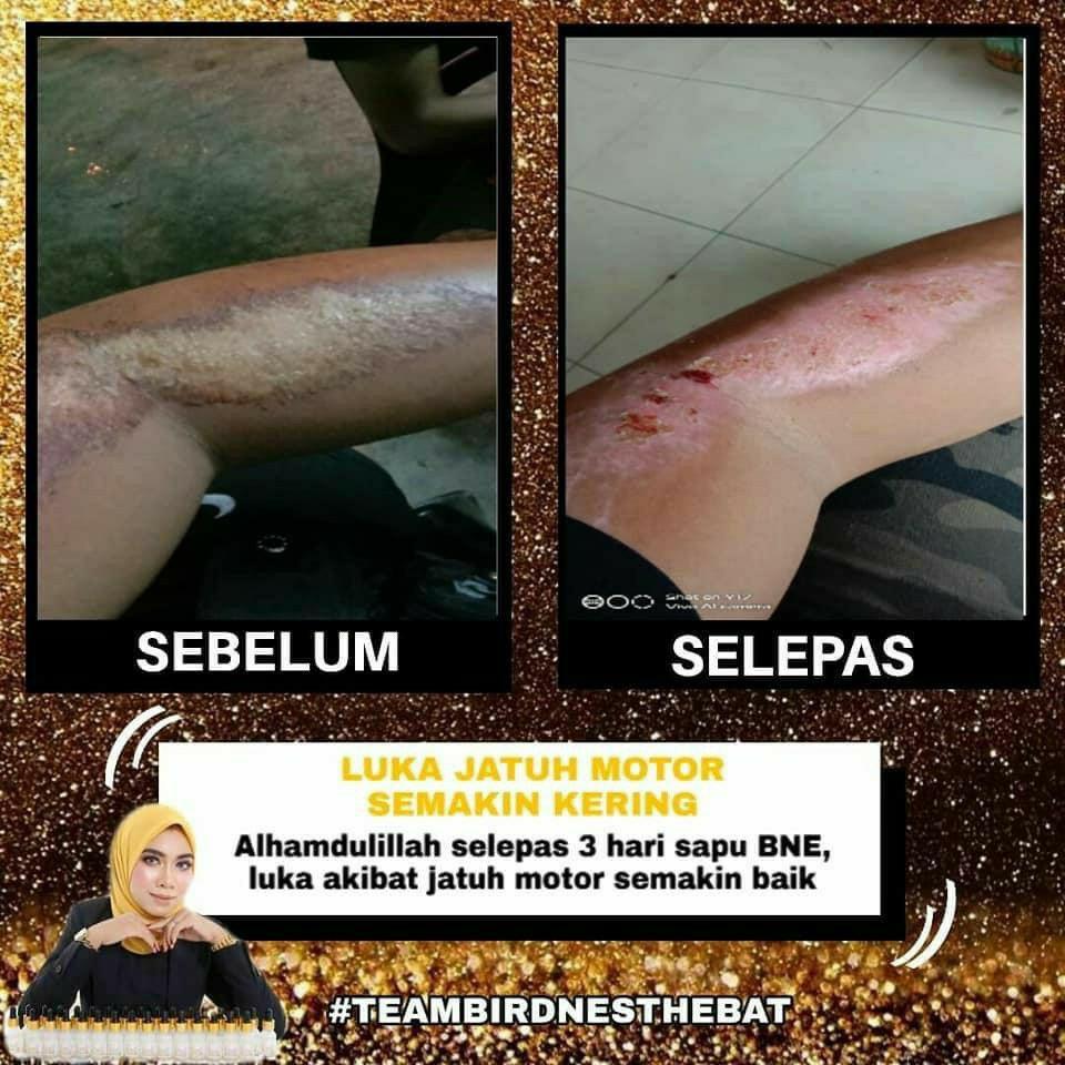 SERUM BNE / BIRD NEST ESSENCE SERUM / ACNE / JERAWAT ...