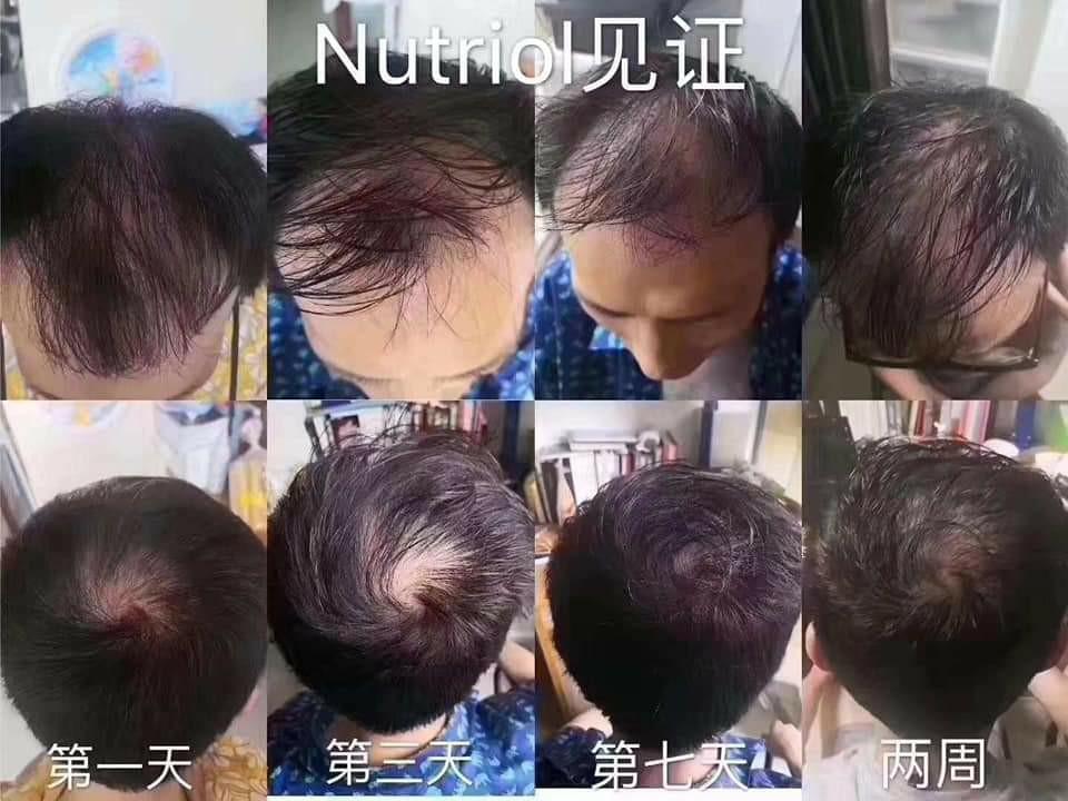 ageLoc Nutriol Scalp and Hair treatment (Category: Hair) located in Singapore. Submitted by home_based_biz (Listing ID 1021134458, Image 3). Description: Our scalp aged faster than our face! At 13yrs old, our scalp will start to age 😱 Do dont just take care of your face and neglect your hair ! First in the world that your scalp can reset younger ! Establish healthier scalp, grow fuller thicker hair. ageLOC Nutriol Scalp & Hair Treatment 🔹Promot