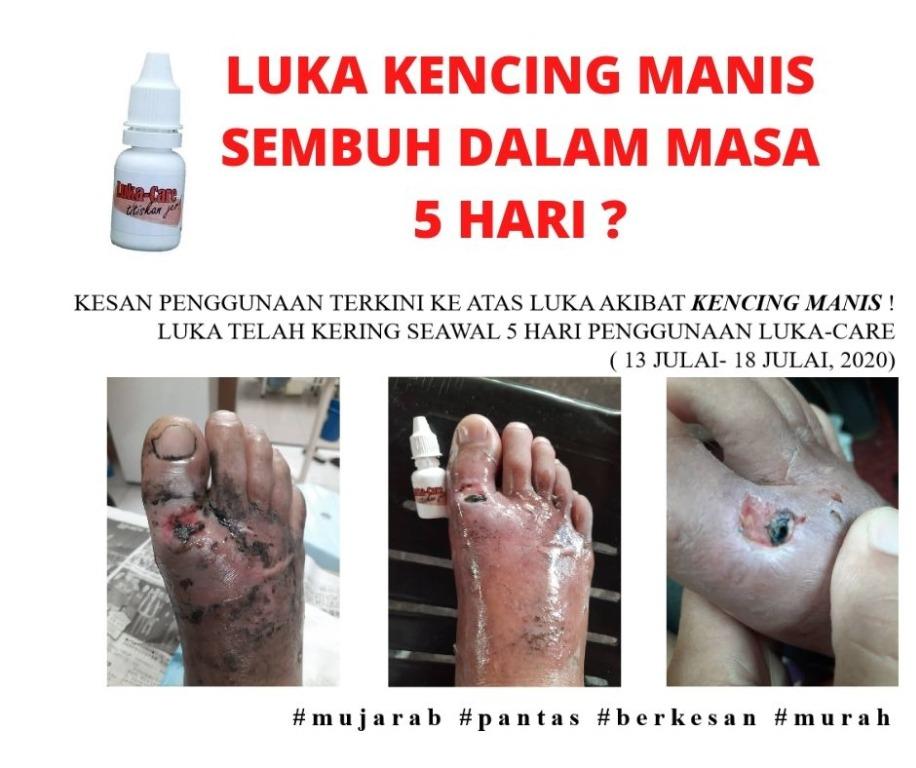 Ubat Untuk Keringkan Luka Kencing Manis