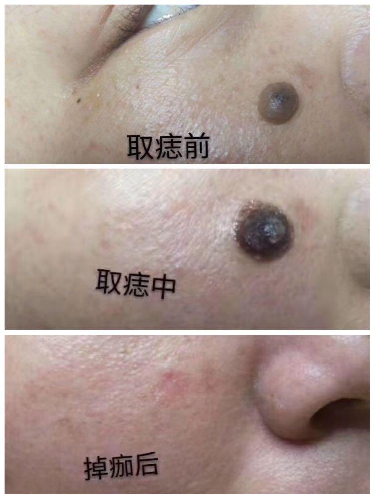 Moles And Skin Tags Removal Ç¥ç£ Æå¹³å°¤ Lifestyle Services Beauty Health Services On Carousell