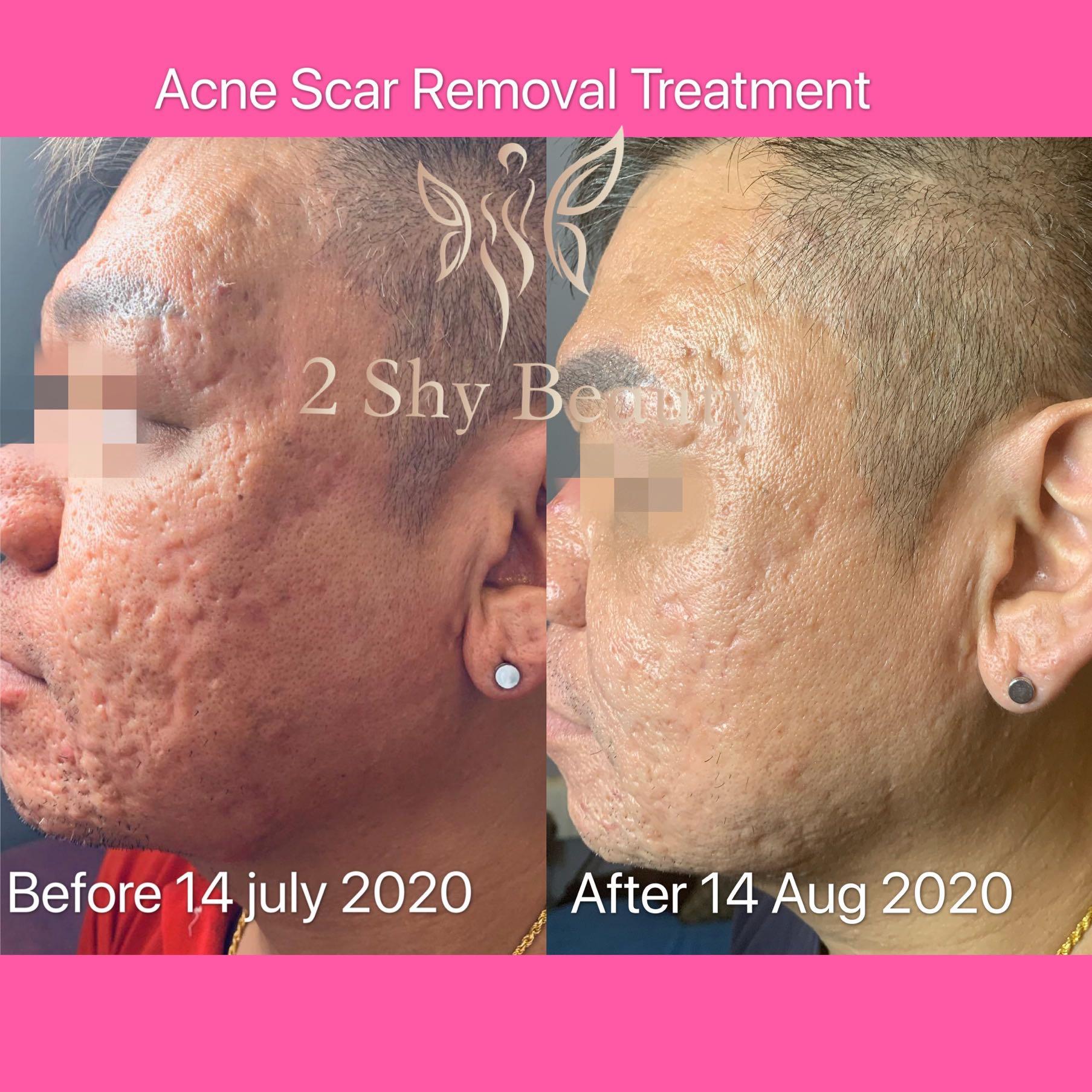 Acne Scar Removal Treatment Health Beauty Face Skin Care On Carousell