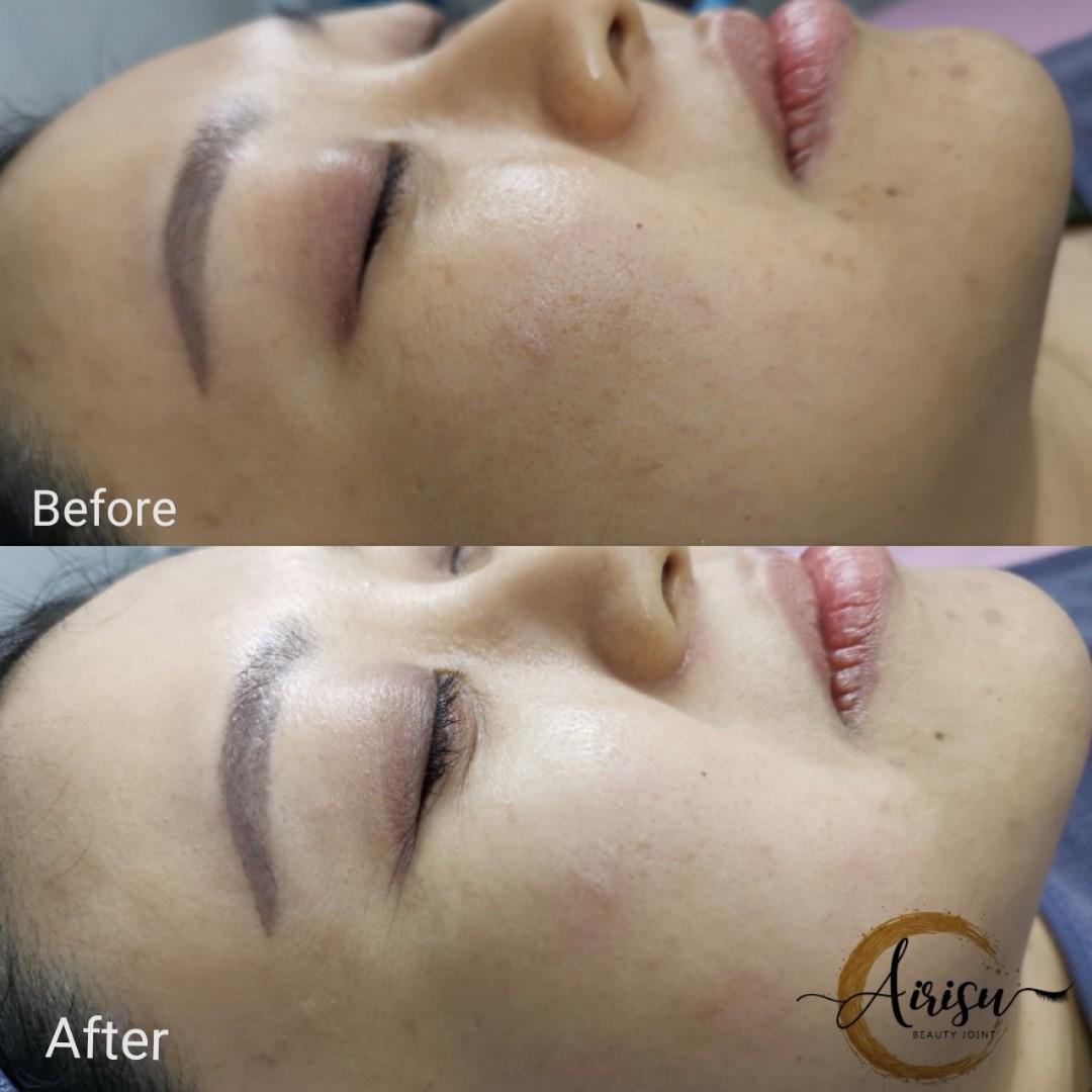 BB Glow Skin Treatment @ Clementi (Category: Beauty & Health Services) located in Singapore. Submitted by abjoint (Listing ID 1029835999, Image 1). Description: first trial $58 BB Glow skin Treatment is a combination of powerful tinted serum applied using Microneedling method . Clearer , smoother and whiter skin in just one session . However it takes few session to achieve flawless skin for results to last longer ..