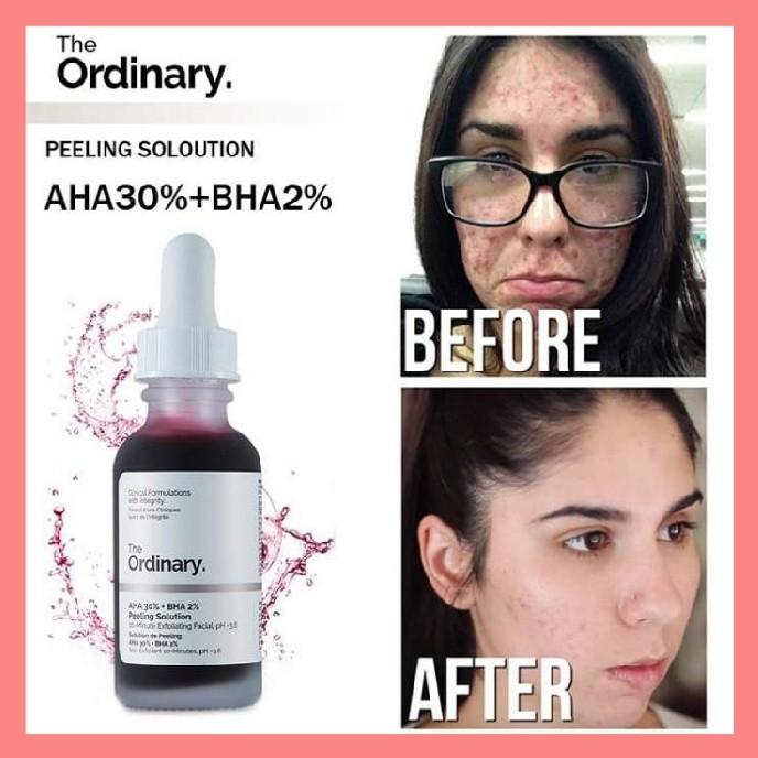 The Ordinary AHA 30% BHA 2% Peeling Solution (Category: Face Care) located in Quezon City. Submitted by beautyskin_mnl (Listing ID 1031439293, Image 3). Description: The Ordinary. AHA 30% + BHA 2% Peeling Solution Facial Serum Remove Acne Scars Whitening Skin Care 30ml. Description: Alpha Hydroxyl Acid (AHA) exfoliate the skin's top most surface for a brighter and more even look. Beta Hydroxyl Acid (BHA) exfoliate the skin more deeply to clear fo