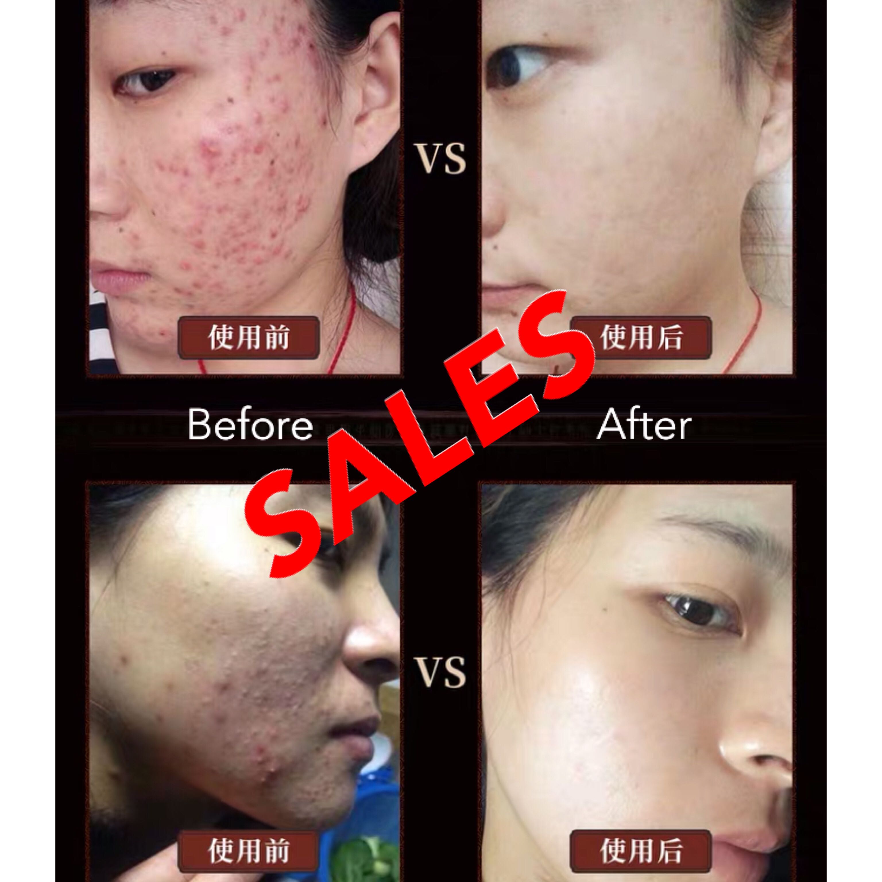 urgent control acne cream