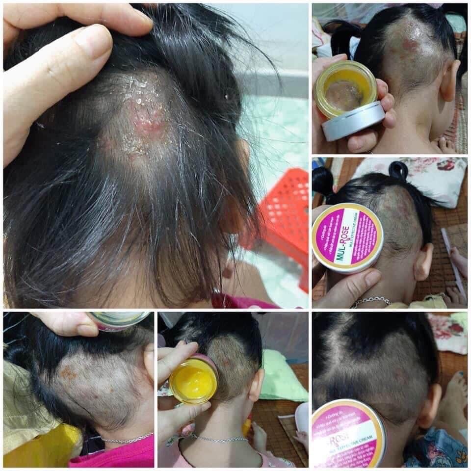 Remove Fungal scalp Cream, Beauty & Personal Care, Face, Face Care on  Carousell