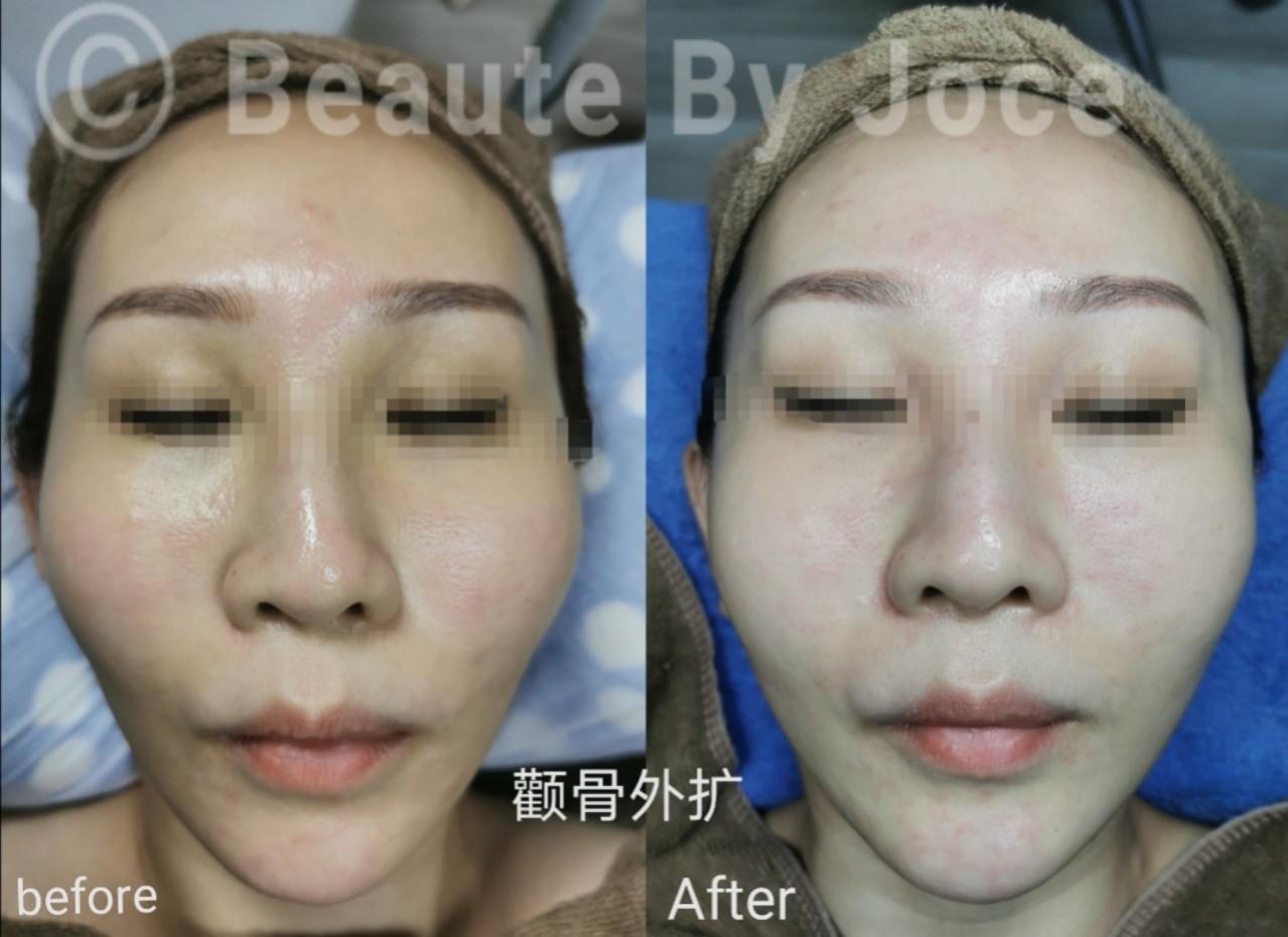 Non Sugical Japan Face Lifting Face Slimming Beauty Lifting 徒手日式整形 小脸术 小v脸 瘦脸 Health Beauty Face Skin Care On Carousell