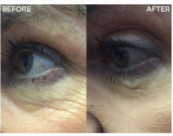 eye bag wrinkles