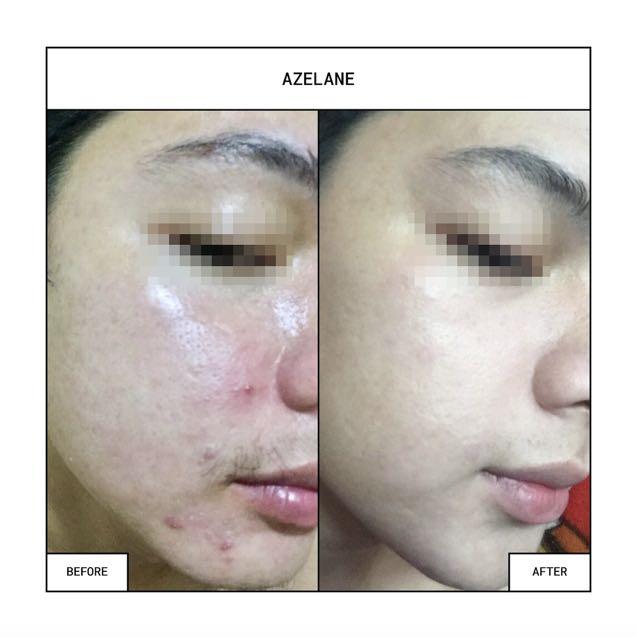 Azelane Clinical Whitening/Oil Control Soap (Category: Face Care) located in San Juan City. Submitted by qclane (Listing ID 1064419950, Image 1). Description: Thousands have spoken! Azelane was created by board-certified Dermatologists for oily, sensitive, and acne-prone skin. Its main ingredient Potassium Azeloyl Diglycinate (PAD) chemically restructures the oil glands to lessen oil production. This leads to lessened acne or pimple breakouts. Tr