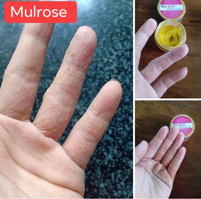 Cream for rashes n itchiness., Beauty & Personal Care, Face, Face Care