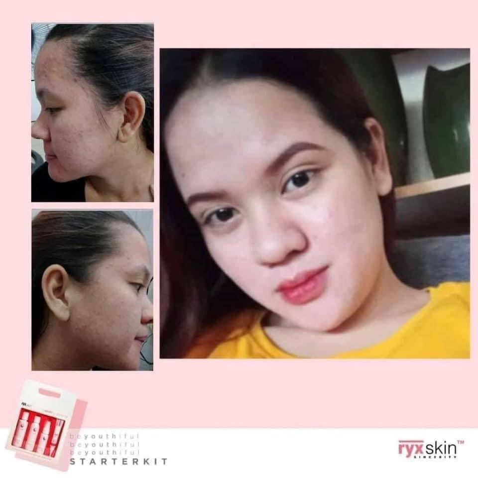 RYX Starter Kit (Category: Face Care) located in Mandaluyong City. Submitted by charlaloooo (Listing ID 1119110880, Image 3). Description: SLAY THE DEAD SKIN AWAY ✨ Exfoliate. Exfoliate. Exfoliate for an acne-free radiant skin. Say bye bye to black heads, white heads, blemishes without using harsh chemicals on your skin. ❤️ Formulated just for YOU! 😍 #SlayTheDay #Ryx #Ryxified #RyxSkinSincerity #RyxSkincerity #RyxSkin #beYOUTHifulStarterKit #Sta