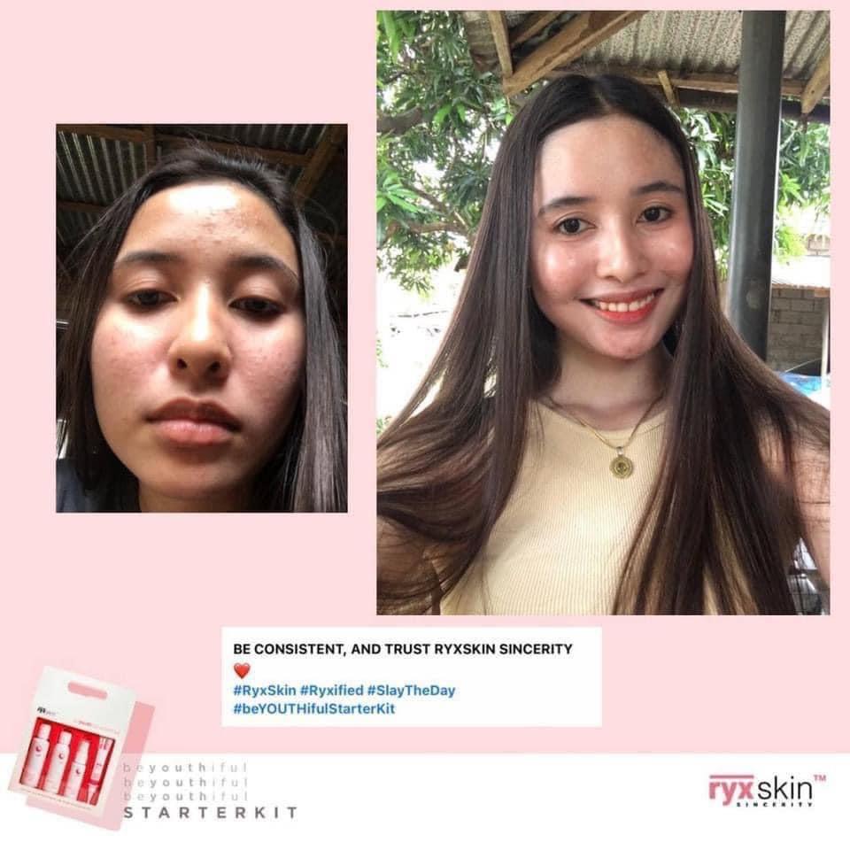 RYX Starter Kit (Category: Face Care) located in Mandaluyong City. Submitted by charlaloooo (Listing ID 1119110880, Image 1). Description: SLAY THE DEAD SKIN AWAY ✨ Exfoliate. Exfoliate. Exfoliate for an acne-free radiant skin. Say bye bye to black heads, white heads, blemishes without using harsh chemicals on your skin. ❤️ Formulated just for YOU! 😍 #SlayTheDay #Ryx #Ryxified #RyxSkinSincerity #RyxSkincerity #RyxSkin #beYOUTHifulStarterKit #Sta