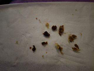 Impacted Earwax Removal 无痛取耳结石