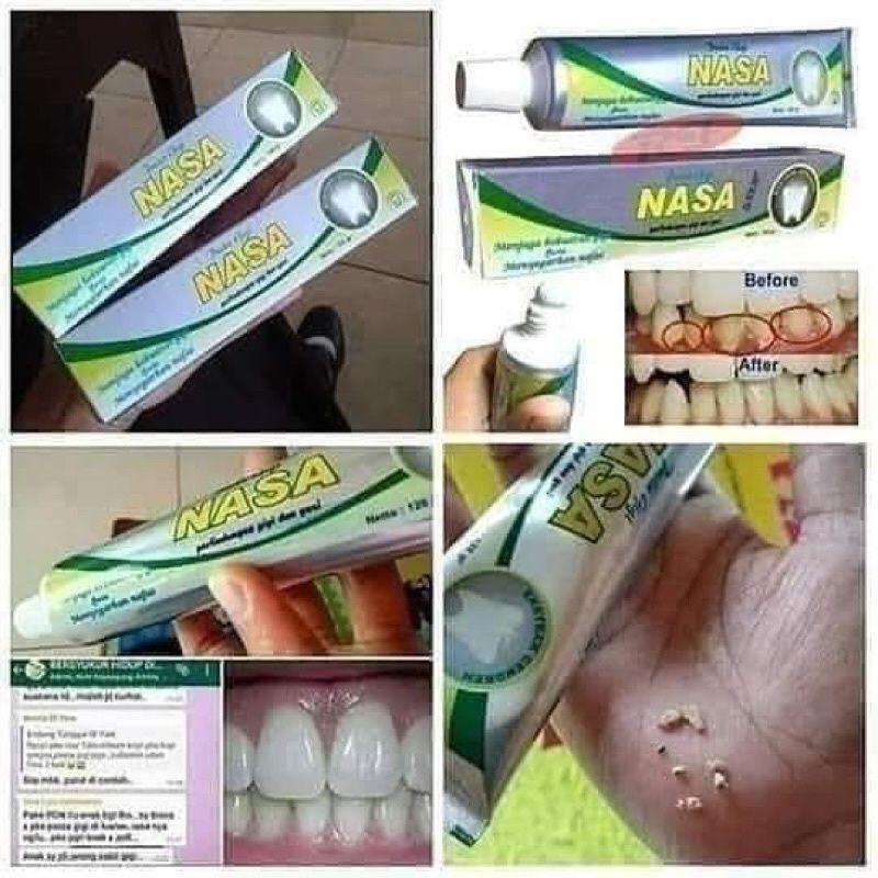 Gigi ubat gigi untuk memutihkan 5 Cara
