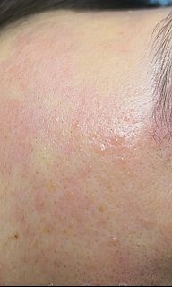 Removal of Warts / Sebaceous Filaments / Pigmentation / Skin Tags / Syringoma64216659420418110