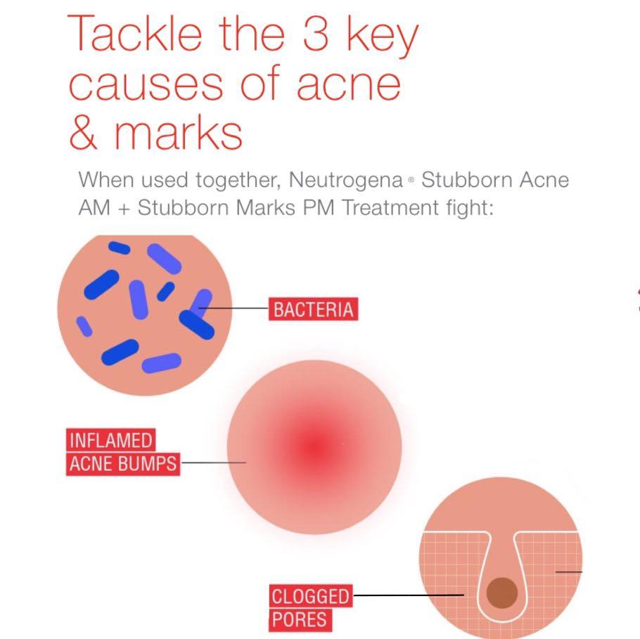 neutrogena stubborn acne am