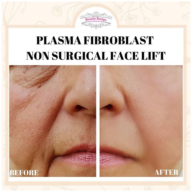 Wrinkles Facelift Plasma Fibroblast Non Surgical Face Lift, Beauty