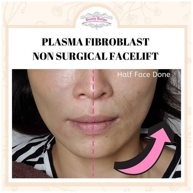 Double Chin / Cheek / Jaw / Forehead / Smile Line Nasolabial Fold