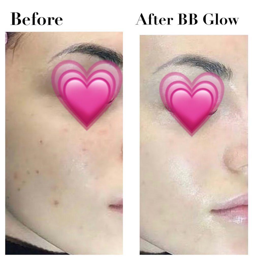 BB Glow skin treatment $80 ( Worth $200) taiseng m (Category: Beauty & Health Services) located in Singapore. Submitted by 93lashlounge (Listing ID 1074177497, Image 3). Description: BB Glow Treatment – is the most advanced development of Korean beauticians for a safe and intensive treatment, whitening, rejuvenation of the facial skin that gives it a soft glow. Radiant, even and with a silky porcelain glow – Korean women are famous for their flaw