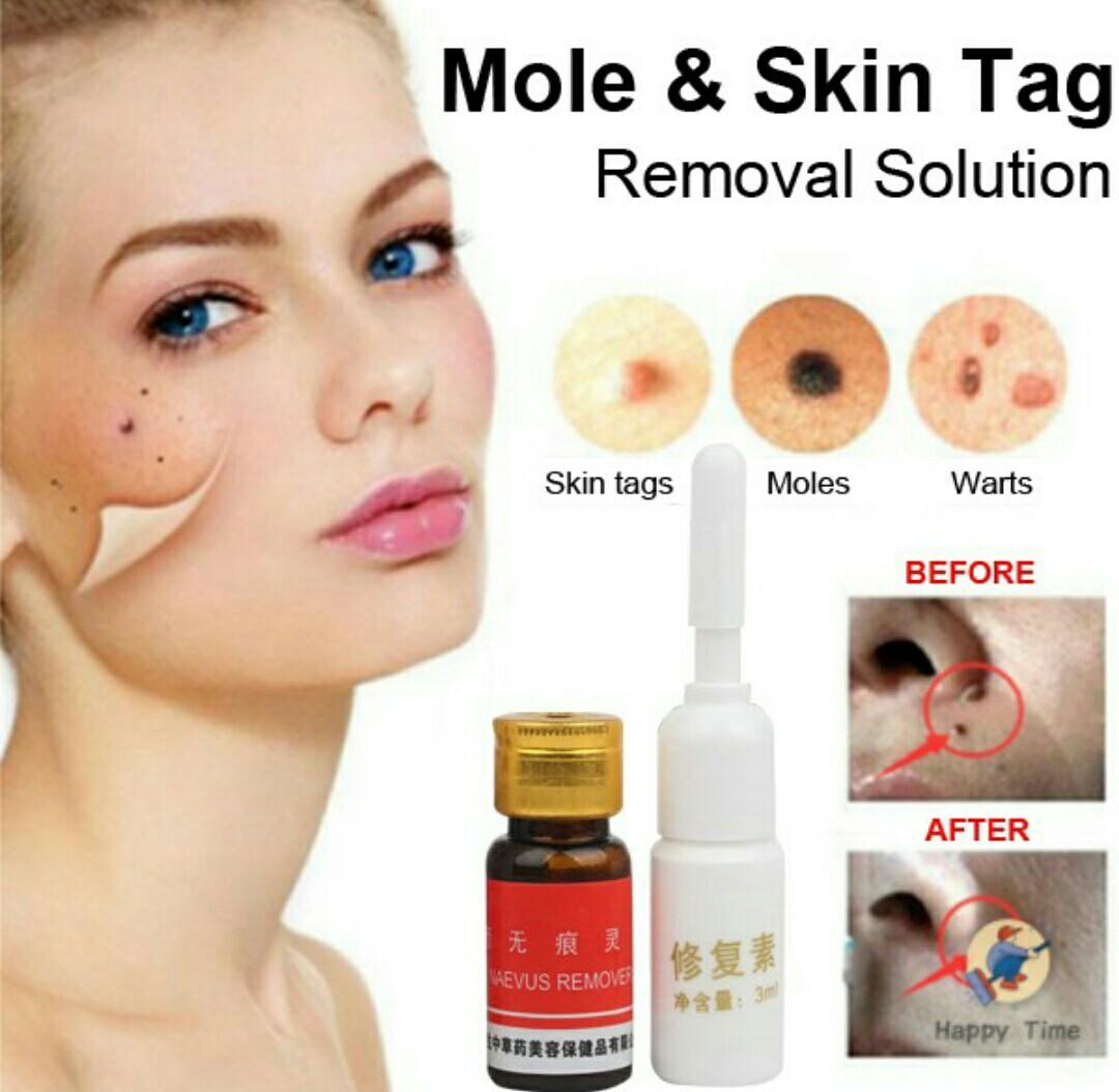 Skin Tag Mole And Wart Removal Beauty Personal Care Face Face Care On Carousell