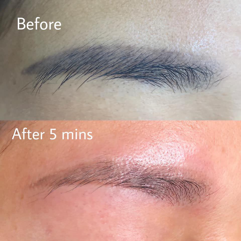 Non Laser Eyebrow Tattoo Removal, Lifestyle Services, Beauty & Health  Services on Carousell