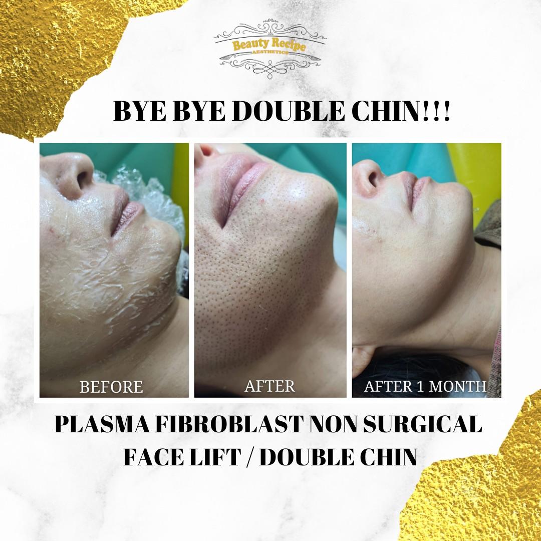 Double Chin Removal with Plasma Fibroblast Non Surgical Facelift