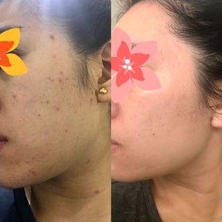 Acne problems