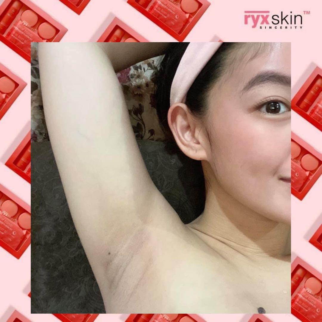 Ryx Clearbomb (Category: Face Care) located in Mandaluyong City. Submitted by charlaloooo (Listing ID 1096040785, Image 2). Description: Before vs. After ✨ 1month of CLEARBOMB SET lang yarnch!! Get yours now for only 300php💖 #RYX #RyxSkin #SlayTheDay #RyxSkinSincerity #RyxSkincerity #ClearBombAdvancedExfoliatingKit #ClearBombEffect #ClearBomb #clearbombfeedback #RyxClearBomb #RyxSkincerityMandaluyong #ryxrejuv #RyxSkinceritySkinCare.