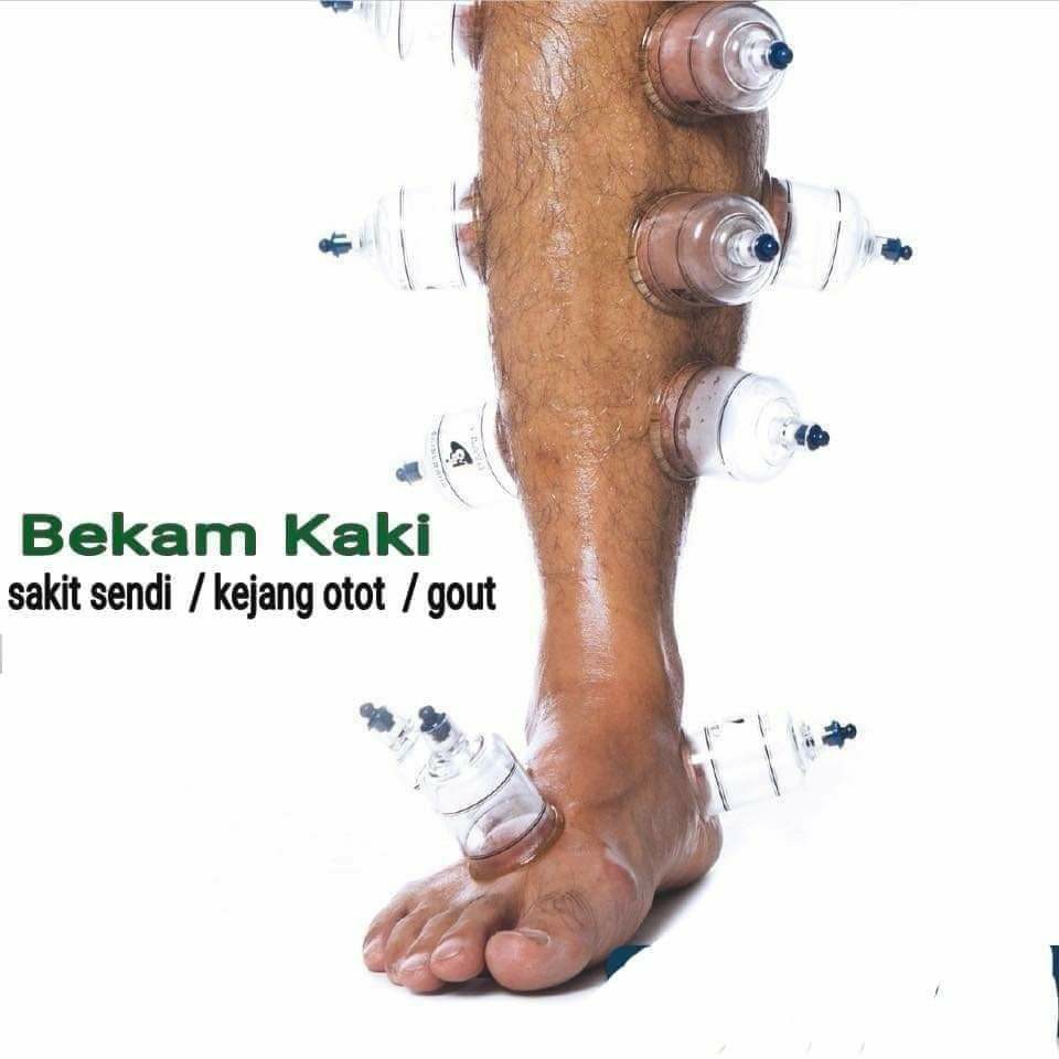 Bekam Darah Hijamah Beauty Personal Care Bath Body Body Care On Carousell