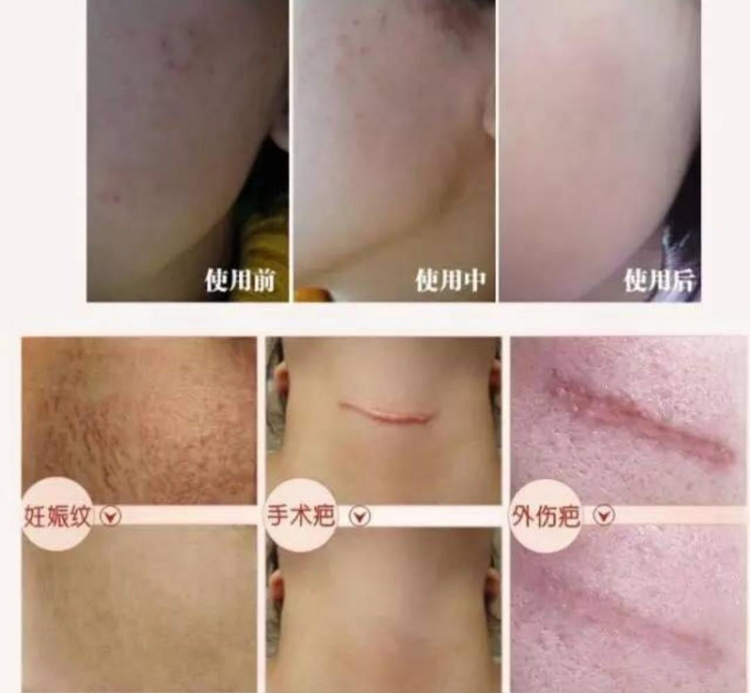 JAPAN MSD SCAR REMOVAL CREAM 10gm, Beauty & Personal Care, Bath & Body