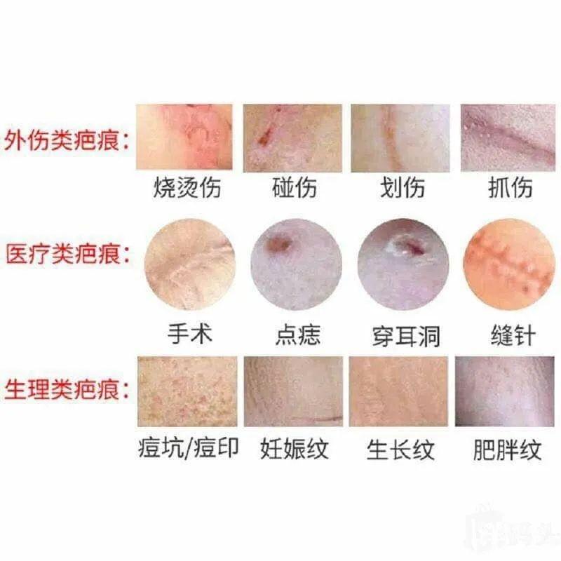 JAPAN MSD SCAR REMOVAL CREAM 10gm, Beauty & Personal Care, Bath & Body, Body Care on Carousell
