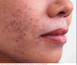 Acne/Spots Treatment