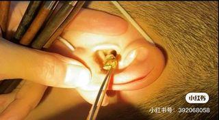 Earwax removal Vietnamese Style in singapore